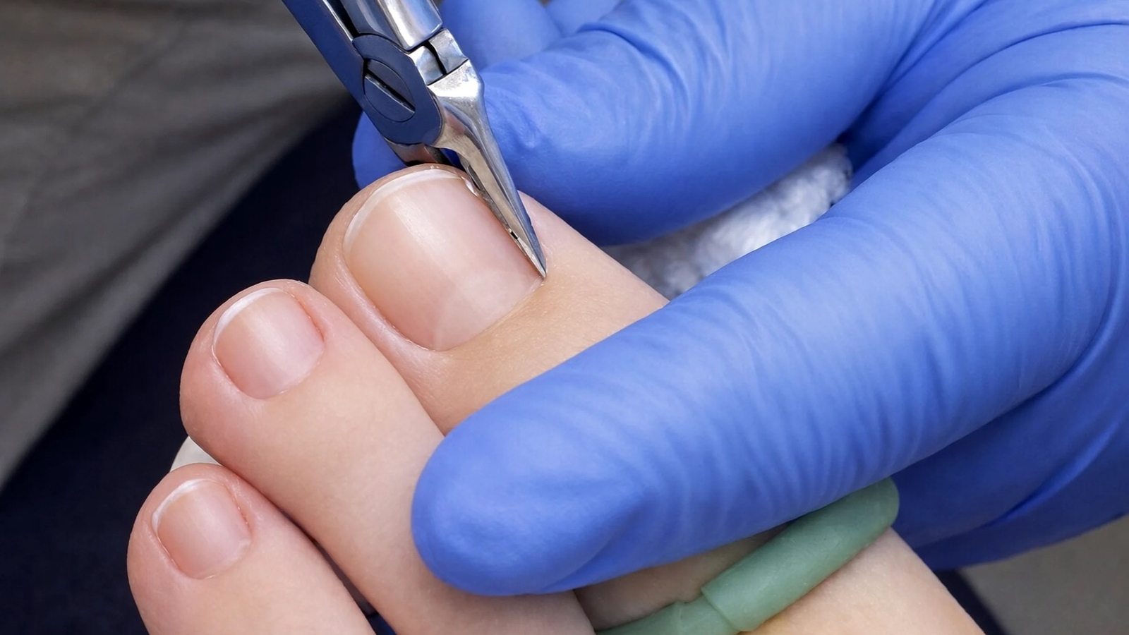 Nail Surgery - Treatment for ingrown or damaged nails